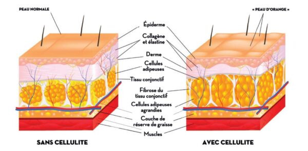 Ma routine beauté 4 comparatif cellulite